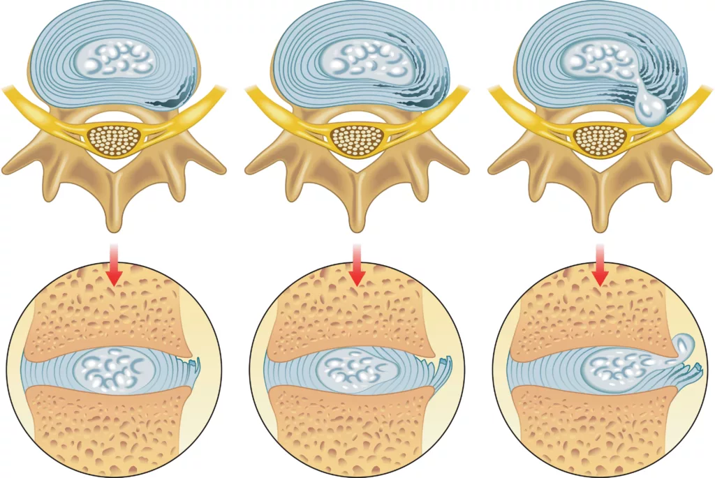 Dolore dopo intervento ernia discale