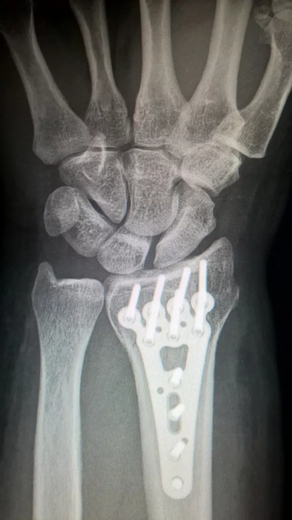 broken arm, plate fixation, titanium plate-2117980.jpg