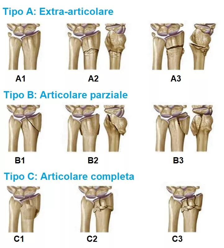 Frattura scomposta polso intervento chirurgico