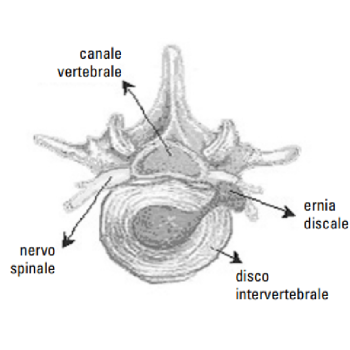 ernia del disco